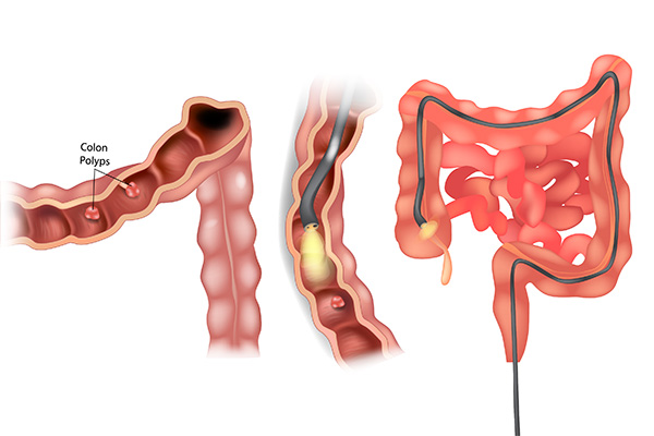 Sigmoidoscopy